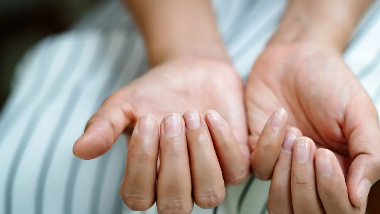 Fegato intossicato: il sintomo che compare sulle unghie